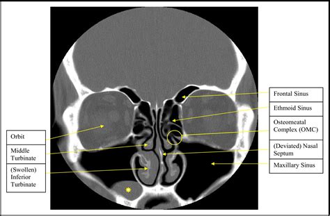 Chronic Rhinosinusitis in Adults - The American Journal of Medicine