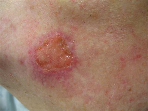 Squamous Cell Carcinoma of the Skin - Dermatology Advisor