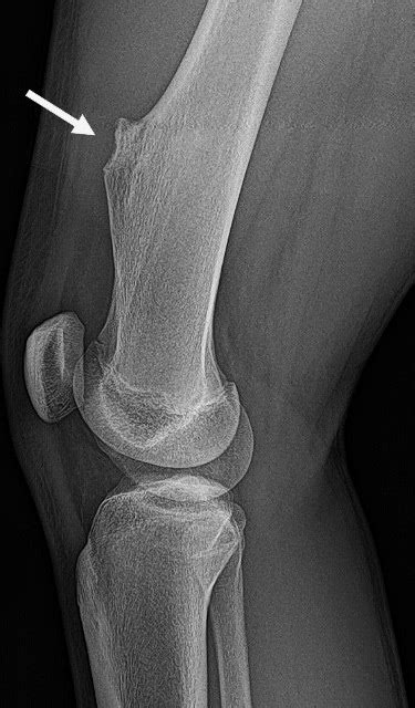 Osteochondroma: Causes, Symptoms and Treatments | HSS (2023)