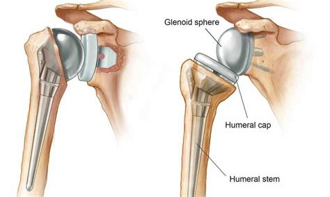 cost of shoulder replacement surgery 2020 - finchmezquita-99