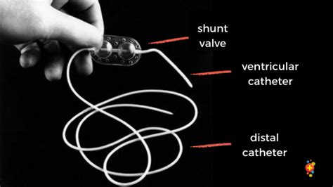 Ventricular Drainage Catheter