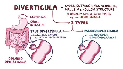 Diverticular disease: Clinical: Video & Anatomy | Osmosis