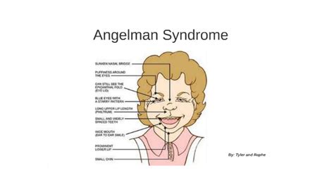 Angelman Syndrome by Tyler Ly on Prezi