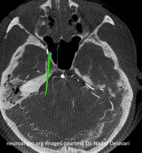 Middle Meningeal Artery | neuroangio.org