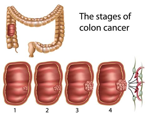 Prevention of Colon Polyps and Cancer | Jackson Siegelbaum Gastroenterology