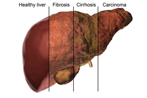 Cirrhosis, Now Linked to NAFLD, Presents Management Challenges - Texas ...