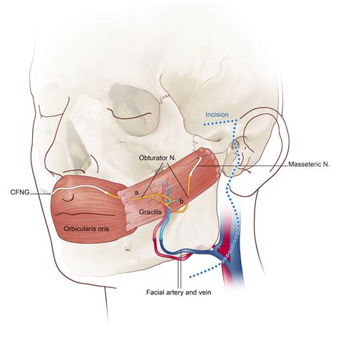 Facial Paralysis | MUSC Health | Charleston SC