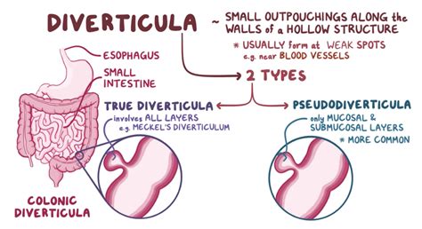 Study Tips: USMLE® Step 1 Question of the Day: Diverticulum Formation