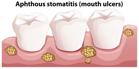 Human Anatomy of Aphthous Stomatitis 302136 Vector Art at Vecteezy