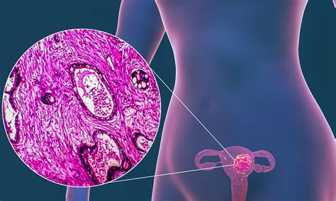 Endometrium Lining Discharge