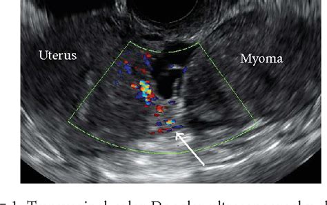 Figure 1 from Torsion of a Subserosal Myoma Managed by Gasless ...