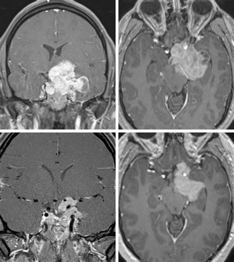 Diagnosing Pituitary Tumor | Expert Surgeon | Aaron Cohen-Gadol, MD