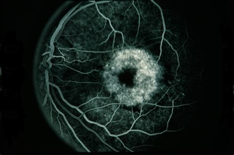 Choroidal Hemangioma - Retina Image Bank