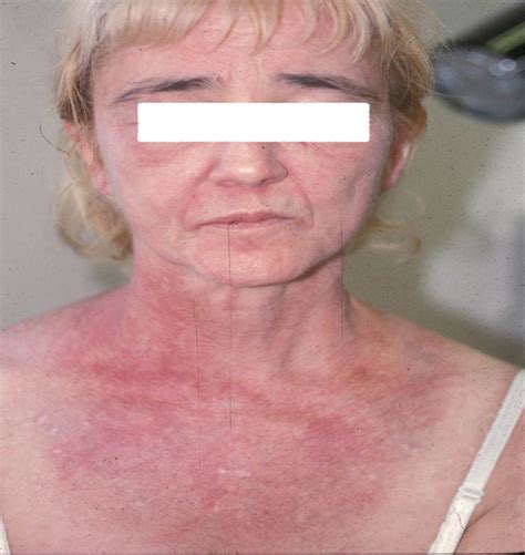 Dermatomyositis - The Clinical Advisor