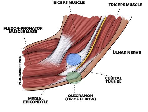 Cubital Tunnel Syndrome - Dr Paul Jarrett, Orthopaedic Surgeon Perth