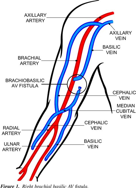 Figure 1 from Irreversible sequela in an arterial venous fistula with ...