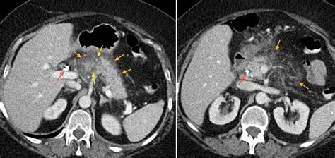 Acute pancreatitis - Radiology at St. Vincent's University Hospital