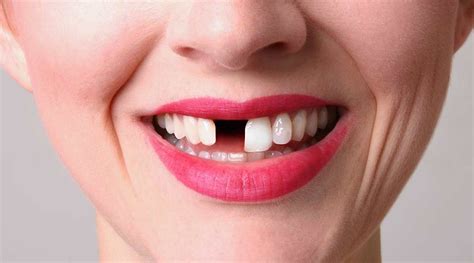 What Can You Do About Missing Teeth ? Smile Denture and Implant Clinic