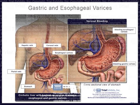 Gastric and Esophageal Varices - Trial Exhibits Inc.