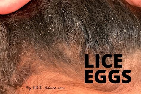 Pictures of What Lice Eggs (Nits) Look Like in Hair: 9 Tips to Spot Them