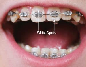 White Spots on Teeth During Orthodontic Treatment