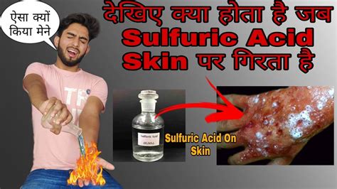 Sulfuric Acid Reaction With Skin | क्या होता है जब Acid Skin पे गिरता ...