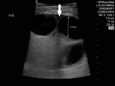 Ventral Hernia Ultrasound