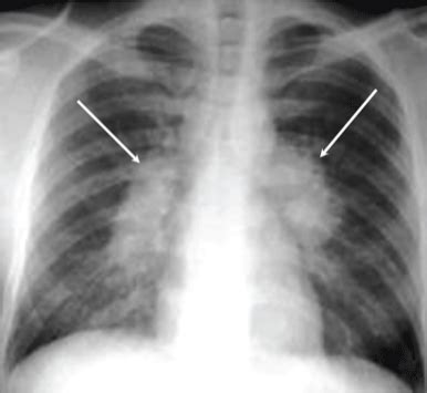 View 23 Tuberculosis Tb Patient X Ray - childviralinterests