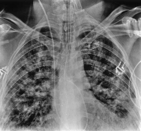 Pulmonary Edema