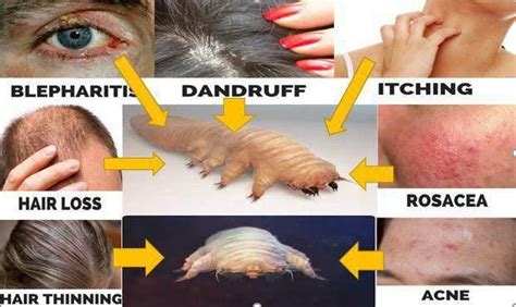 Most Hair Loss And Skin Problems Are Linked To Mites, We Offer A ...