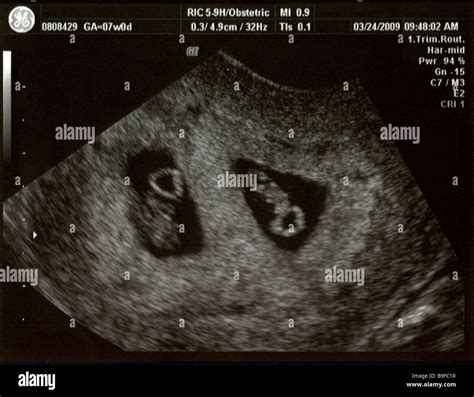 Fraternal Twins Fetal Development