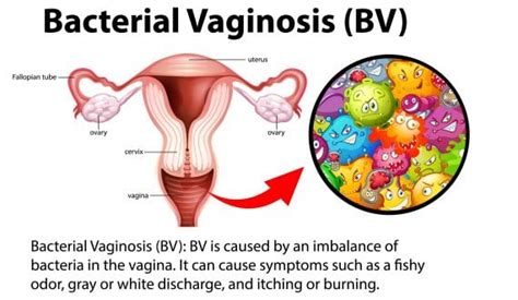 Gardnerella Vaginalis - Symptoms, Treatment, Causes | STDcheck.com