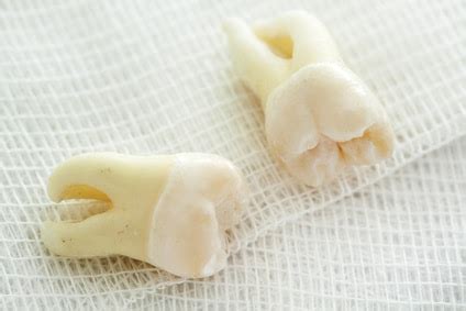 The Patient's Guide To Wisdom Teeth Removal | Padden Dental