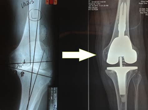 New Technologies in Total Knee Replacement Dr. Stuart Kozinn, MD ...