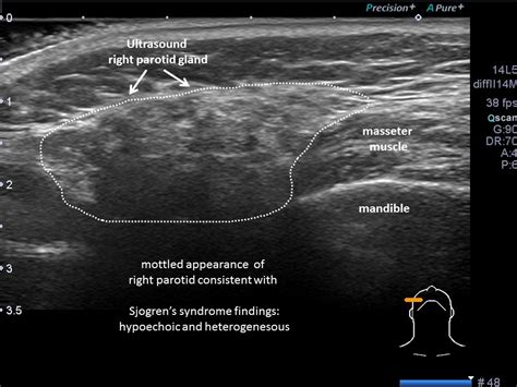 Ultrasound and sialogram of right parotid Sjogrens syndrome | Iowa Head ...