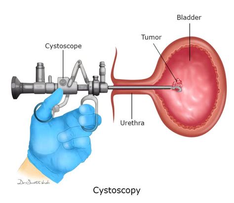 Urinary Bladder Tumour Surgery is done for these SYMPTOMS - Cancerclinix