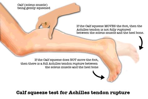 Calf Injuries, Pulls, Strains, Tears, Ruptures and Myositis | Riktr PRO ...