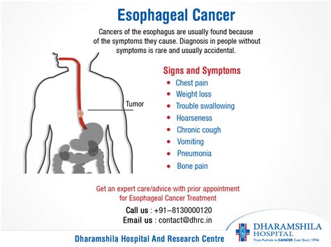 Esophagus Cancer Symptoms Causes Treatment Dr Nikhil Agrawal | The Best ...