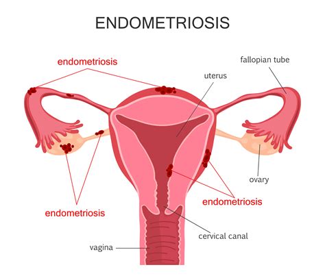 Endometriosis Surgery & Treatment Melbourne — A/Prof Alex Ades