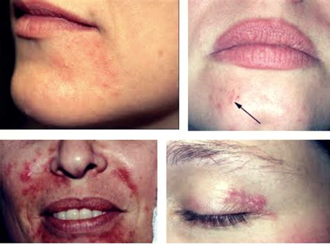 Perioral Dermatitis - Causes, Symptoms, Diagnosis & Treatment