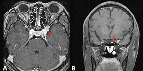 Superior Orbital Fissure Radiology