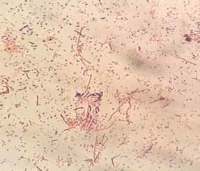 Infection with Streptococcus pyogenes Gram stain. (100X). | Download ...