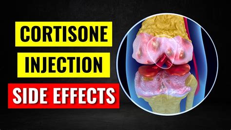 The Single WORST Side Effect of Cortisone Shots