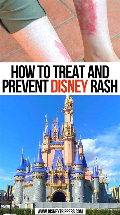 How To Treat And Prevent Disney Rash