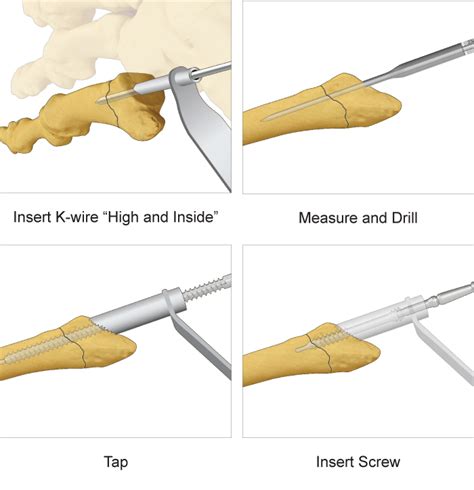 Jones Screw - 5th Metatarsal Implant - TriMed Inc.