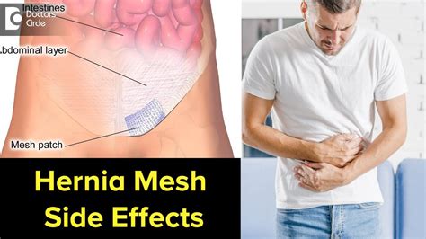 Can Hernia mesh cause problems years later? Signs, Symptoms, Treatment ...