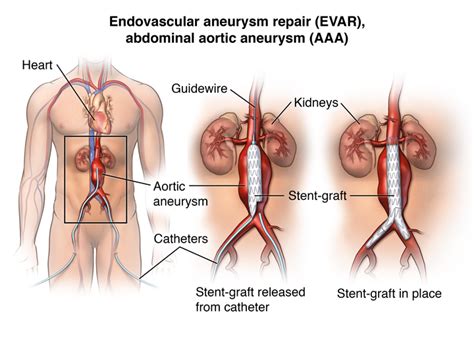 Abdominal Aortic Aneurysm - Stanford Medicine Children's Health