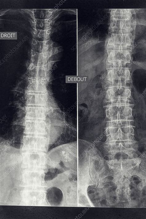 Osteoarthritis of the lumber spine, X-ray - Stock Image - C036/8214 ...