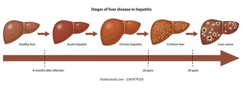 Liver Cirrhosis Stages