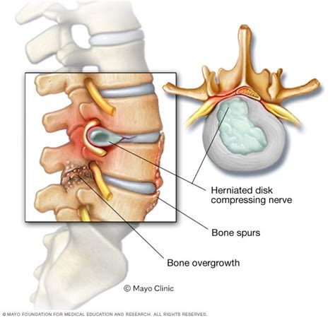 Estenosis del conducto vertebral - Síntomas y causas - Mayo Clinic